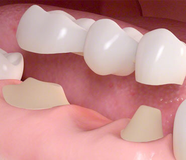 services-09 Crowns & Bridgets