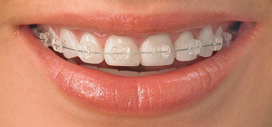 Ceramic braces Ceramic Braces