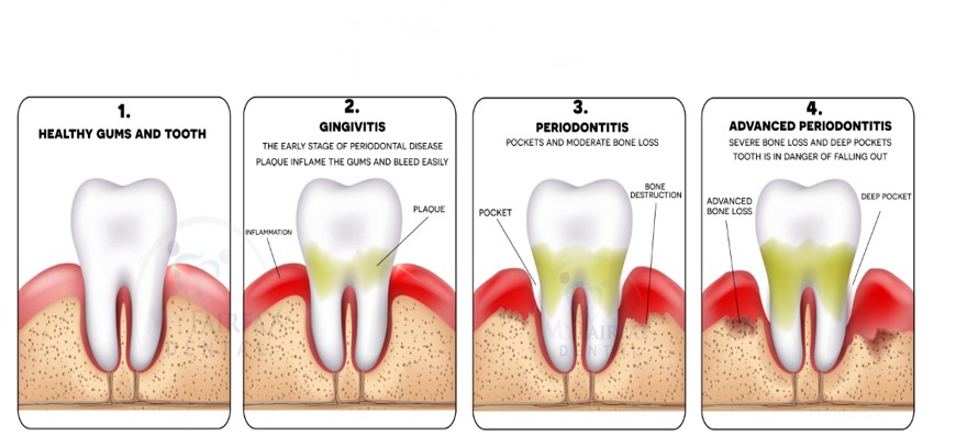 Gingivitis in Stages Gingivitis in Stages