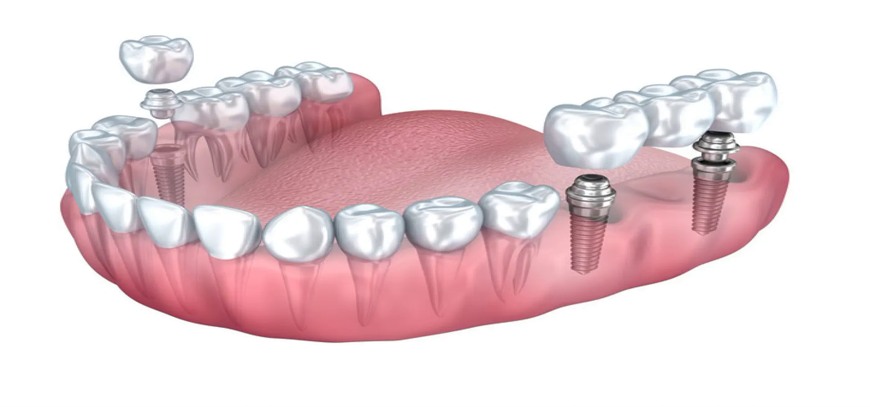 Sheffield-implant-bridge Implant bridges