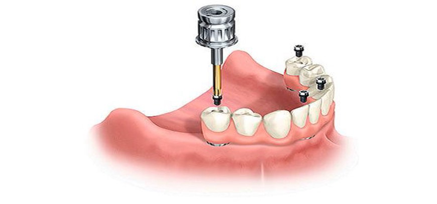 all-on-four-dental-implant All-on-4