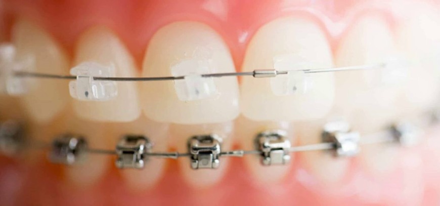 damon braces Damon Braces