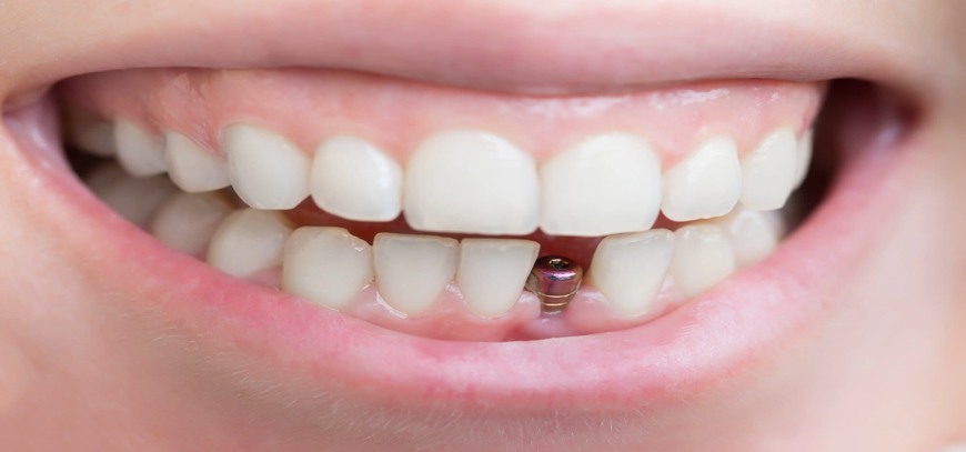 dental-implants Dental Implant