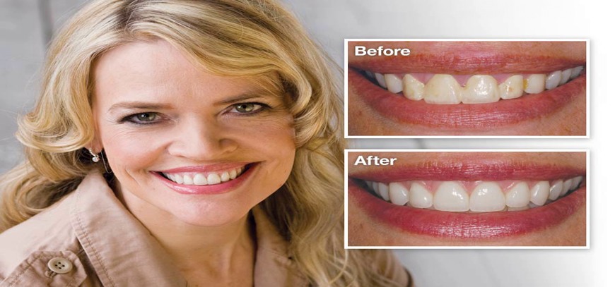 porcelain-veneers-before-after Veneers