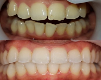 Tooth whitening Tooth whitening