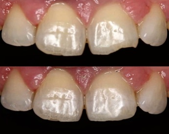 IMG-20211204-WA0003 Composite bonding and smile restoration